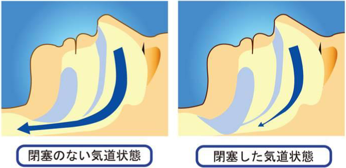 睡眠時無呼吸症候群